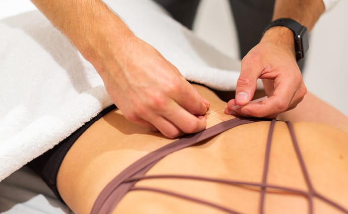 Dry Needling or Acupuncture