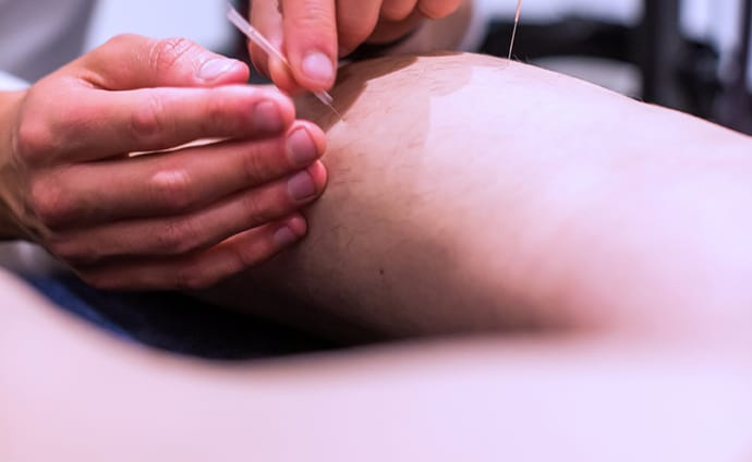 physio treatment dry needling a patients calf
