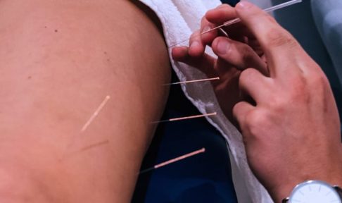 physio treatment dry needling a patients thigh
