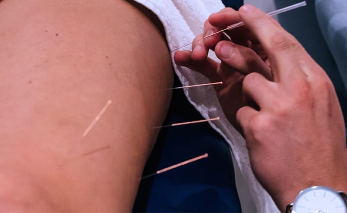 physio treatment dry needling a patients thigh 